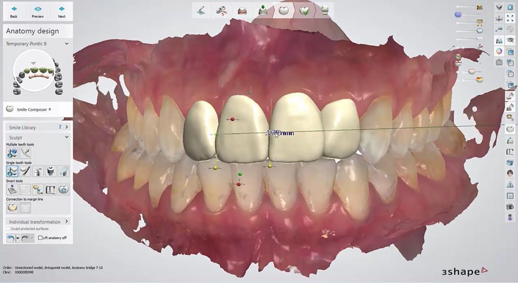 Screenshot 3Shape Dental Designer